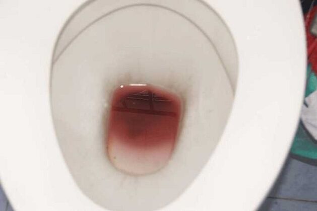 Κηλίδες στους άνδρες όταν διεγείρονται